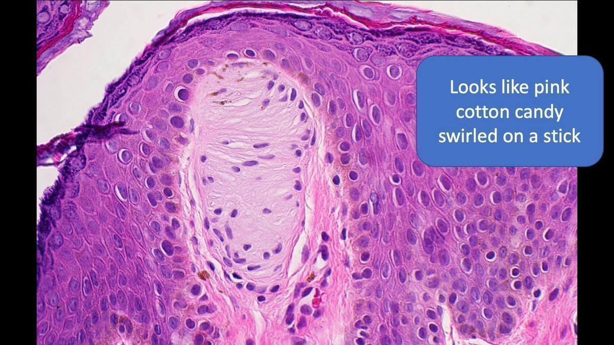 JMGardnerMD's tweet photo. What’s this cute skin structure? Where is it most often found? 
Answer ✅ https://t.co/ycbtaJyYZV
#pathology #pathologists #pathTwitter #dermpath #dermatology #dermatologia #dermtwitter #histology #anatomy https://t.co/ClvHQhN4AD