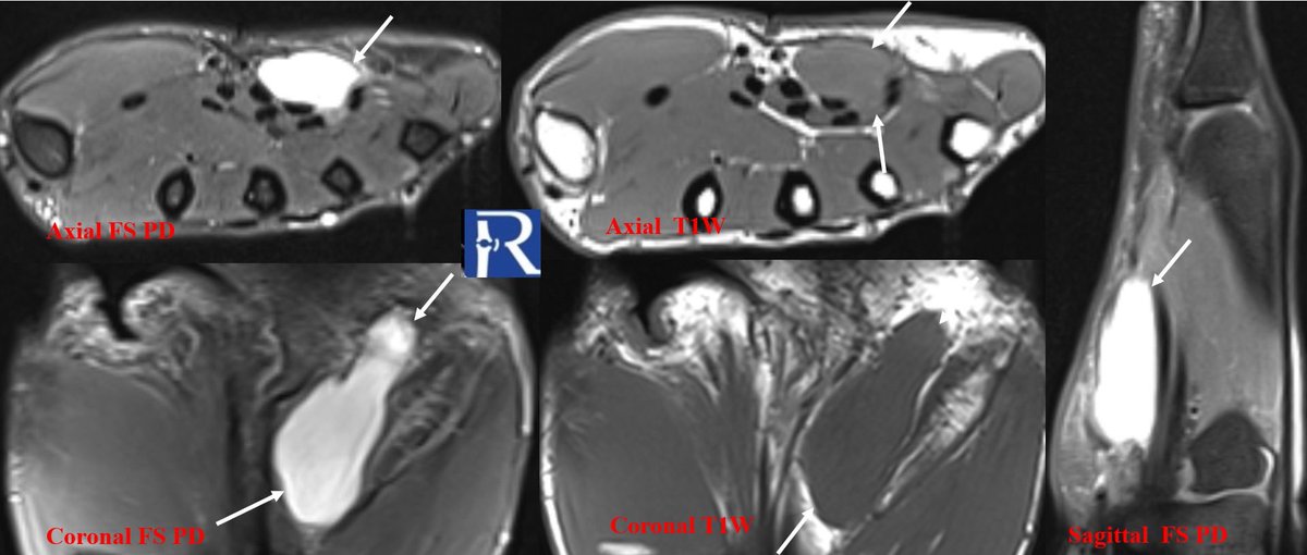 radiologybmj's tweet photo. A Cyst-Like Hand Mass That Wasn’t a Cyst
More information: https://t.co/MGatnyIDRn
#Radiology #MSKRadiology #MusculoskeletalRadiology #DiagnosticImaging #MRI #MRImaging #HandMRI #SoftTissueTumor #SynovialSarcoma
#SarcomaAwareness #RadiologyEducation #TeachingCase #Radiopaedia #RadiologyCase #MedicalEducation
