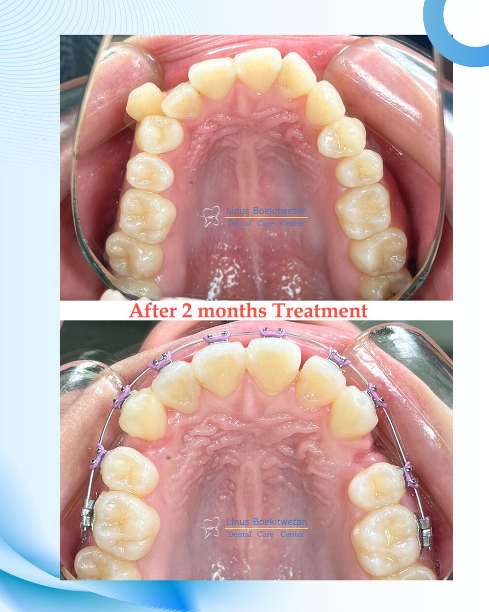 DrgLinus's tweet photo. One step closer to my dream smile 😁

#drglinus #behelgigi #beheltransparan #clearaligner #kawatgigi #braces https://t.co/o81A8vEsgj