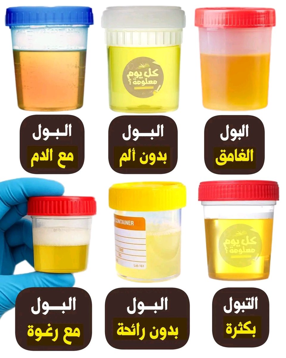 8iff6's tweet image. ✅️ البول الغامق : بسبب استهلاك الأطعمة التي تحتوي على عوامل تلوين طبيعية مثل الشمندر - الرمان ...
✅️ البول بدون ألم : شيء طبيعي جداً 
✅️ البول مع الدم : بسبب عدوى البروستات - عدوى المثانة
✅️ التبول بكثرة : بسبب داء سكري - عدوى جهاز البولي - حمل المرأة - قلق - مدرات البول…