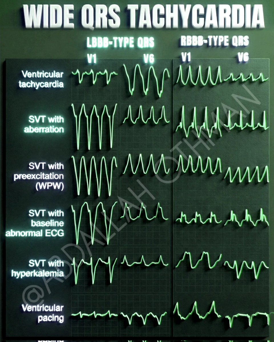 CardioBeat_'s tweet image. Wide QRS Tachycardia
facebook.com/share/p/15PgtZ…
1️⃣ Ventricular tachycardia (VT)
2️⃣ SVT with aberrancy
3️⃣ SVT with preexcitation (WPW)
4️⃣ SVT with baseline abnormal ECG
5️⃣ SVT with hyperkalemia
6️⃣ Ventricular pacing
 #Cardiology #ECG #VTach #SVT #MedEd #CardiacElectrophysiology #ACLS