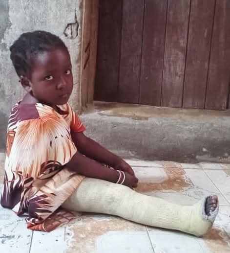 PolycarpMDM's tweet image. Mtoto Khairath Salum (05) mkazi wa Chanika jijini DSM, alizaliwa na tatizo liitwalo "Congenital Pseudarthrosis" ambalo hupelekea kuvunjika kirahisi. Kutokana na tatizo hilo, mwaka 2023 alivunjika mguu wake wa kulia akiwa anacheza. Alipelekwa Hospitali ya Nguvukazi (Chanika) na