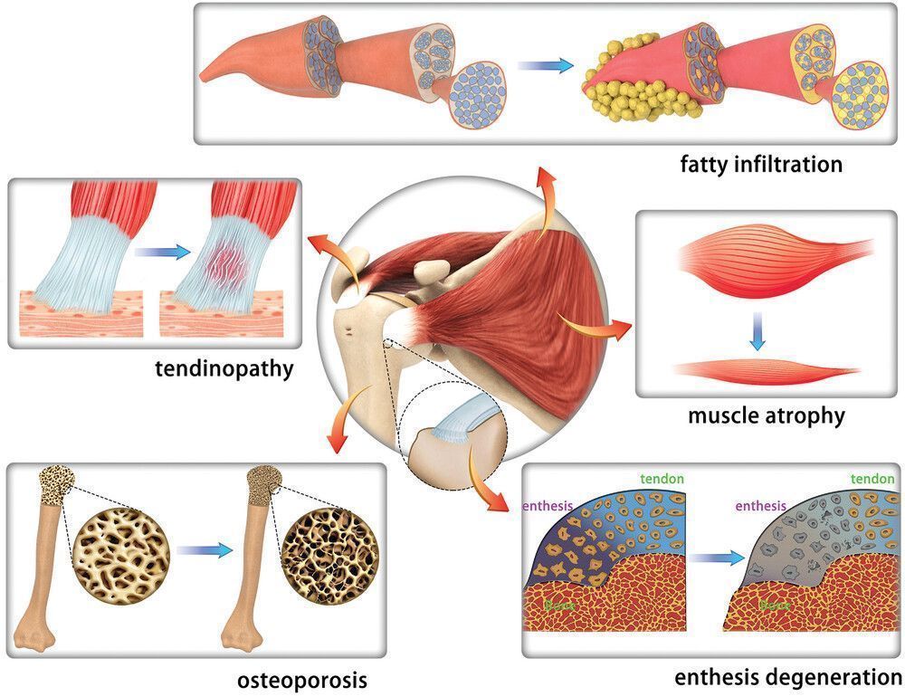 Ageing-related pathological degenerations in rotator cuff 

☑️muscle atrophy
☑️muscle fatty infiltration
☑️degenerative tendinopathy
☑️enthesis degeneration
☑️osteoporosis

onlinelibrary.wiley.com/doi/full/10.10…