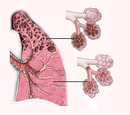 El humo del #tabaco produce una pérdida importante de elasticidad en el tejido pulmonar, lo que conlleva un envejecimiento acelerado de los pulmones. Aprende más sobre #EPOC en #EscuelaEPOC buff.ly/OOzGgj2