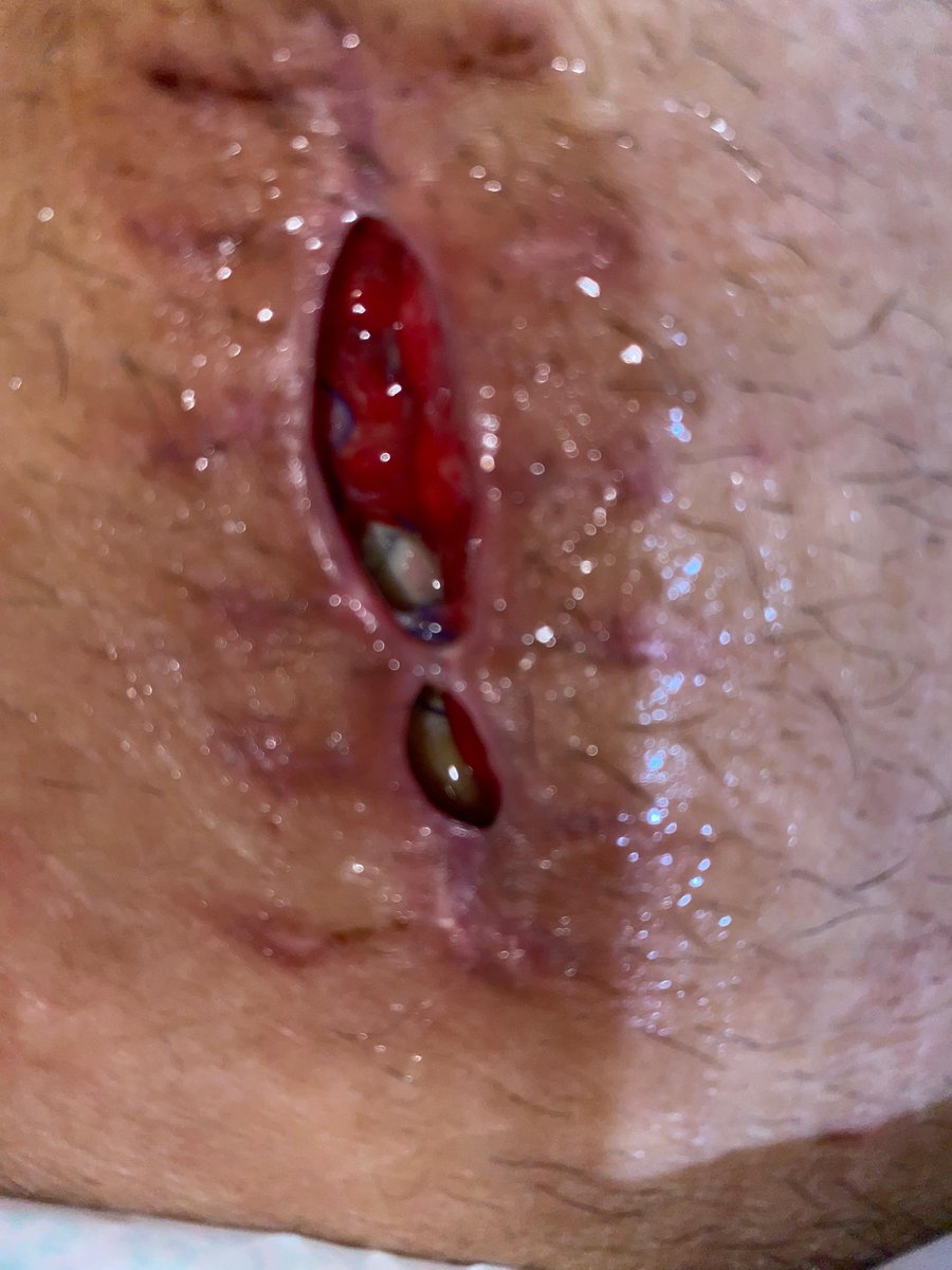 Lukanya semangkin mengangak pasca jahitannya dilepas. Yang putih itu sel lemak apa usus ya ?

Nunggu besok baru ditangani lagi.