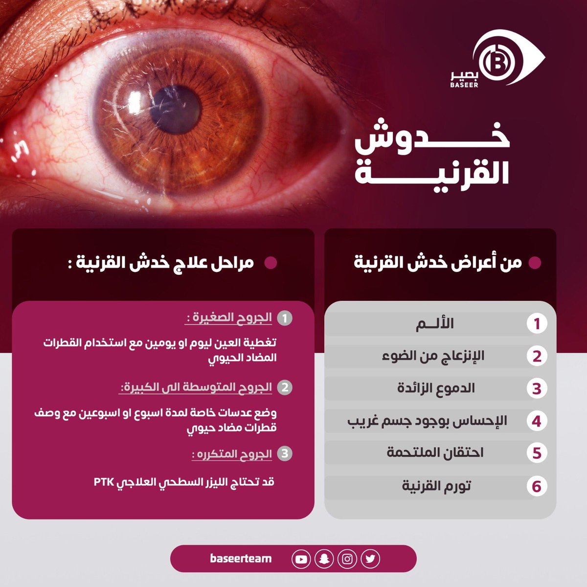 خدش #القرنية من أكثر الإصابات شيوعاً و تكون مؤلمة و مزعجة وان كانت بسيطة و بشكل عام أن إهمال المتابعة مع طبيب العيون قد يؤدي لقرحة بالقرنية ونقص شديد في الرؤية.. 

تعرف على الاعراض ...و مراحل العلاج ⬇️⬇️

<a href="/6abeb_/">#صوت_الطبيب🩺</a> 
#صوت_الطبيب