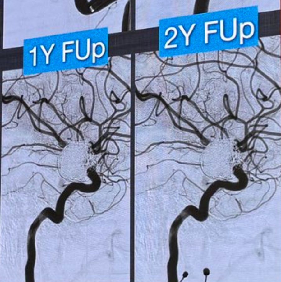 NeuroBaiter's tweet photo. @DanniDiestro @vitorpereiracan @LINNConline The 1- and 2-year follow-ups look too identical to truly be separate studies— even the bone artifact and the reflux to IMAX are exactly the same. This is my judgment-free comment. https://t.co/oCMcaaZKjI