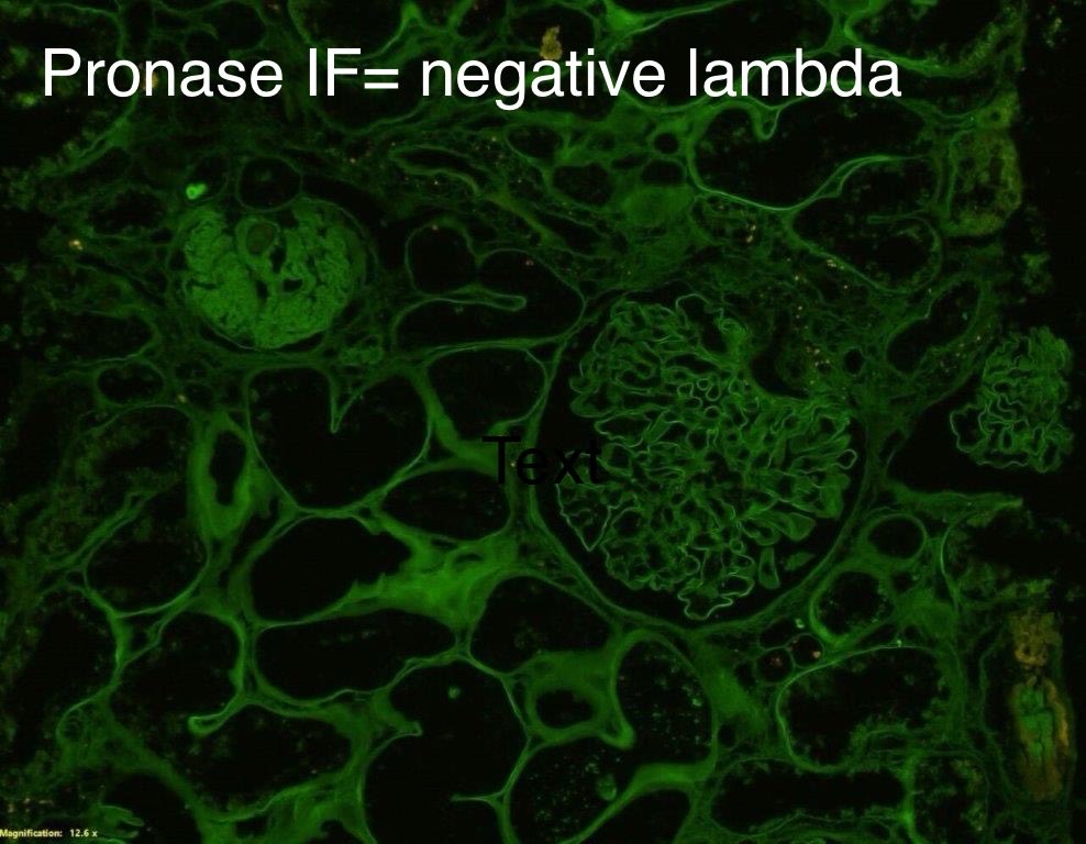 Difficult unless you have seen it before.

CRYSTAL STORING HISTIOCYTOSIS

Often need pronase IF

LM=granules in capillary loops, even mesangium
CD68= +++ histiocytes

IF=Routine IF neg
Pronase IF= granules +++ kappa, neg lambda

EM= Crystals

60-yr with AKI &amp; IgA kappa gammopathy