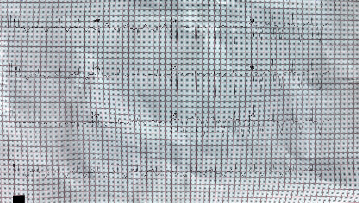 iBurhanMD's tweet photo. 55 yo female with chest pain, findings?

#Cardiovascular #MedTwitter #Cardiology #CardioEd #CathLab #omi #Catholic #CardioTwitter #MedicalEmergency #MedicalStudents #MedicalEducation #EKG #ECG #Paramedics #STEMI #OMI #Cardiologist #ecgbot #ACS #ecgrhythm #PMcardio #FOMed https://t.co/QgkYw9EXGR