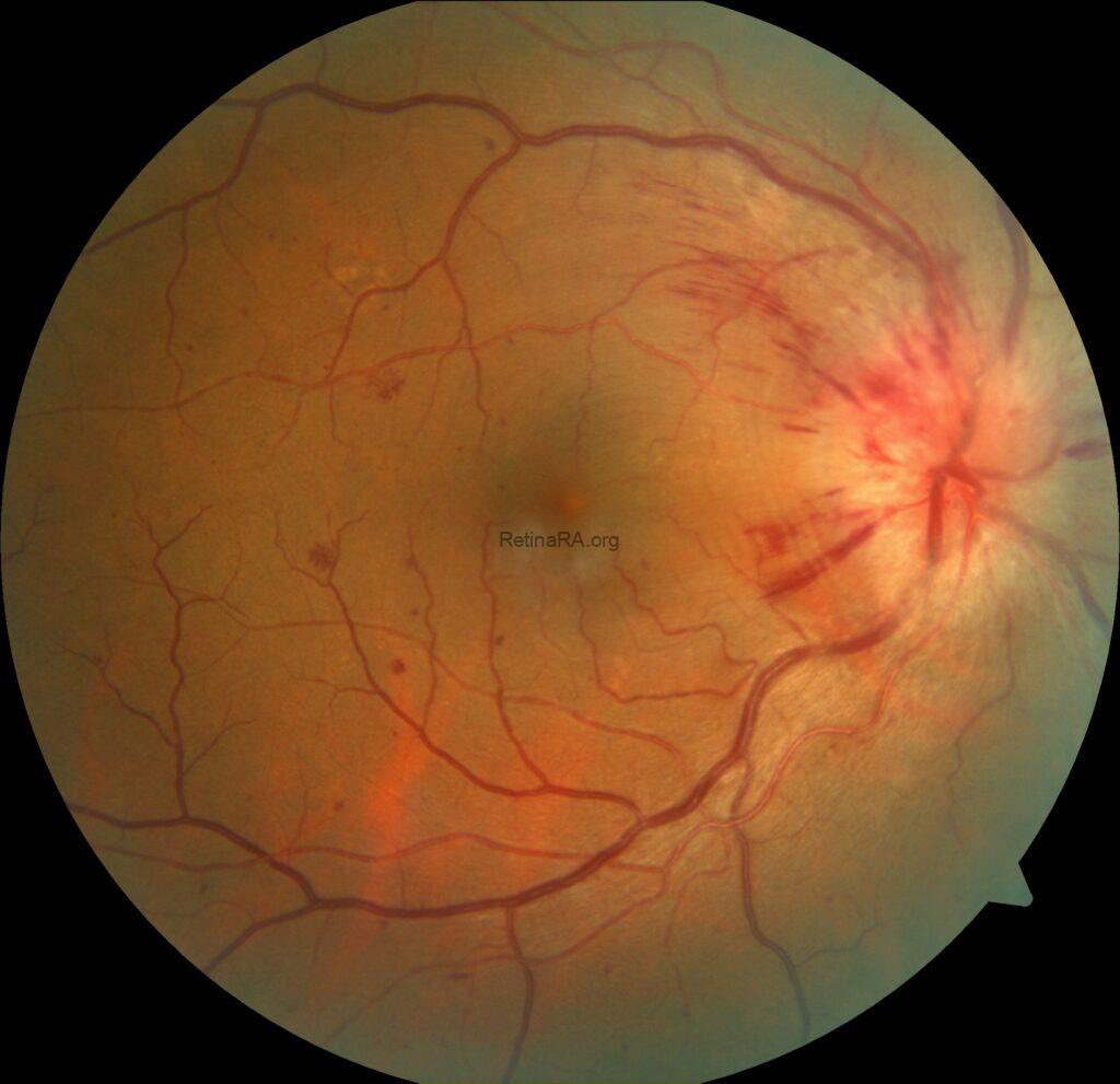 معروف ان ارتفاع السكر يسبب اعتلال الشبكية السكري، ولكن هل تعرف ان ارتفاع ضغط الدم ممكن يسبب مشاكل في الشبكية ؟ 

#صحة_العيون 
#شبكية