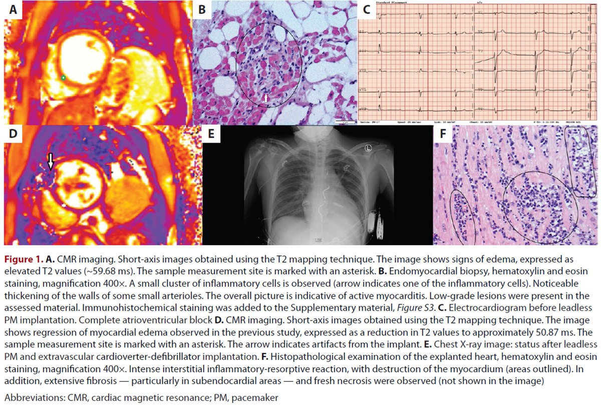 heart_polish's tweet photo. Editors' Insights: From #mononucleosis to heart #transplantation: An uncommon course of Epstein–Barr virus-associated #myocarditis.
https://t.co/dXyxXHmYg5
#PolishHeartJournal #CardioTwitter #HeartNews #Cardiology #HTx @J_Malinowski73 @nikardiologii https://t.co/zgzAGXfTLU