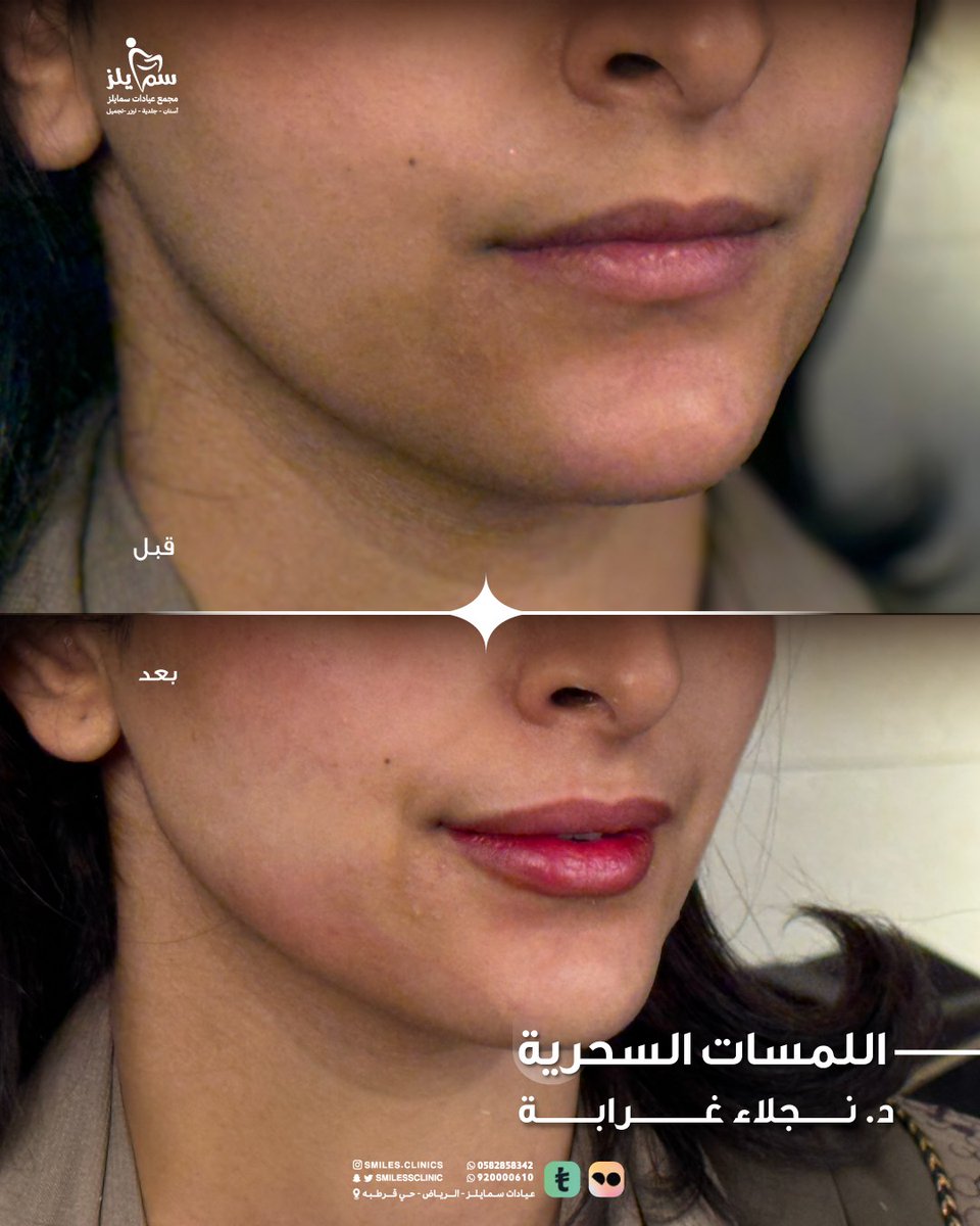 فيلر فل فيس د نجلاء غرابة