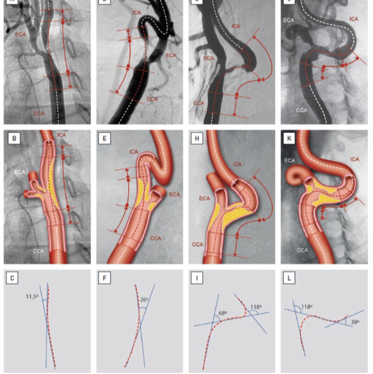 DrJayMohan's tweet image. Great chapter on Carotid Artery Stenting on @PCRonline 

What are your thoughts on the new CREST 2 data and the new push for carotid artery stenting for asymptomatic severe disease? 

#CardioX #Carotid #PAD