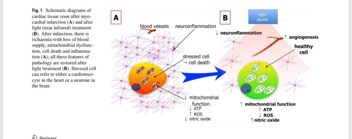 DrGrimmMD's tweet image. Your Heart and Brain Respond to Light More Than You Think. Us Docs need to pay attention

✳️ AFTER MI
✳️ AFTER CVA
What may happen if we had NIR BEFORE the diagnosis???

Heart attacks and strokes share something almost nobody teaches in medical school.

When blood flow collapses,…