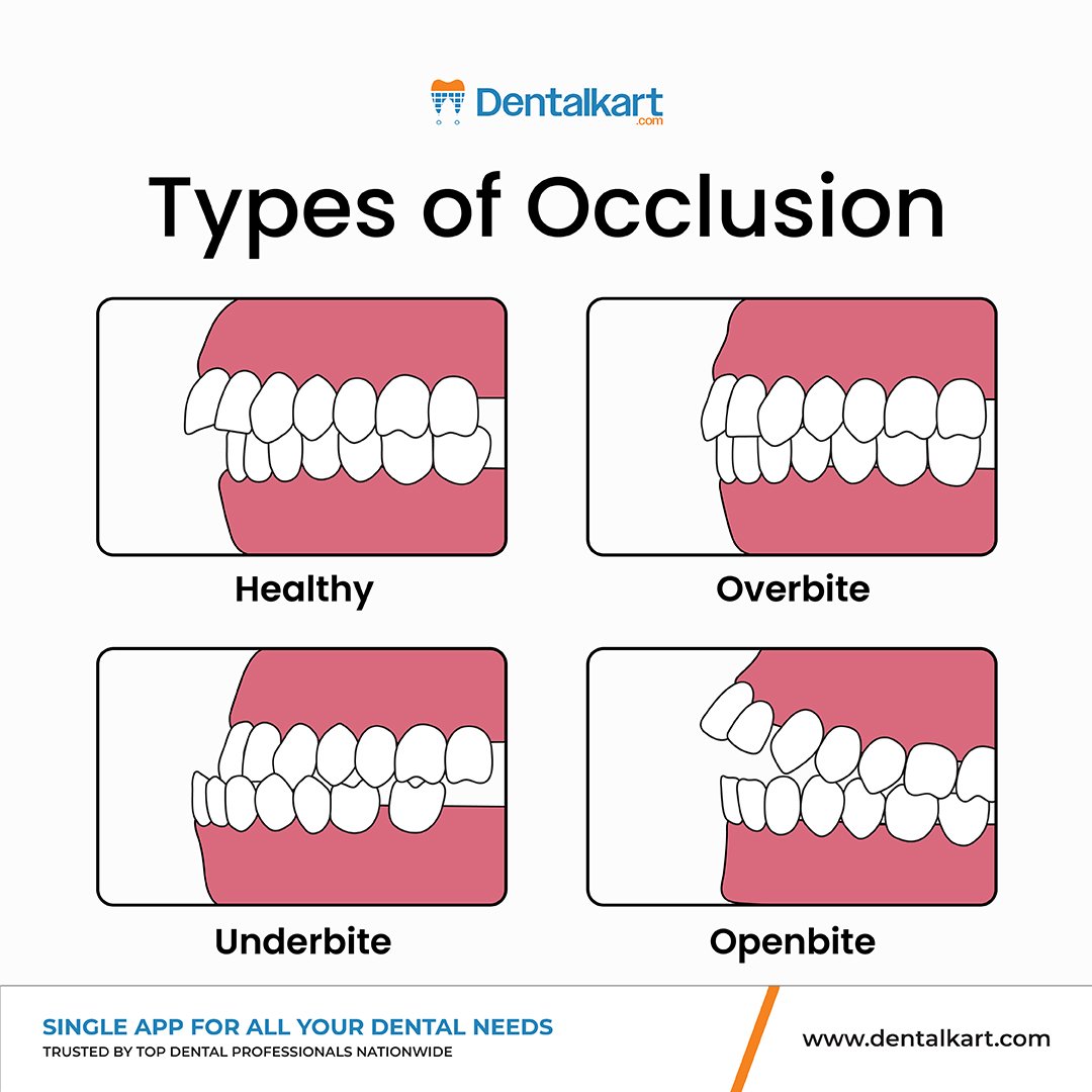 Dentalkart's tweet image. Types of Occlusion You See Every Day  
From healthy bites to open bites, know what you’re looking at.  
 
Spotting occlusion types early helps plan better, more conservative orthodontic and restorative care.  

#OcclusionBasics #OverbiteUnderbite #OpenBite #Orthodontics…