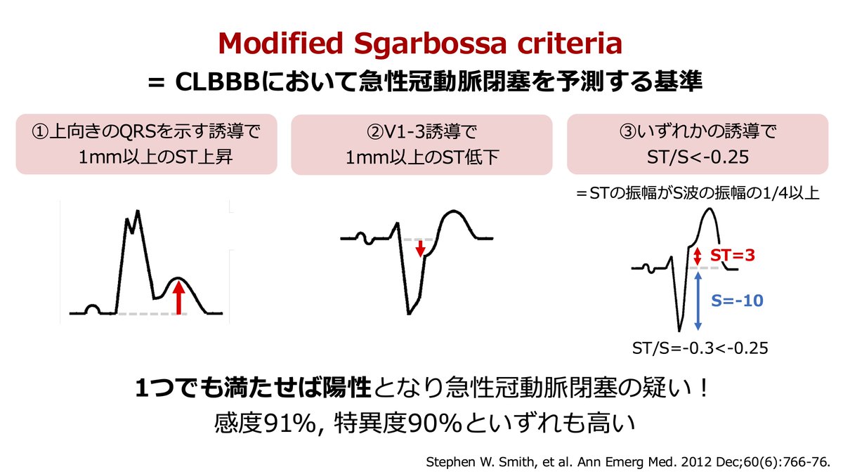 完全左脚ブロック(CLBBB)ではQRSとSTの極性が逆になるAppropriate