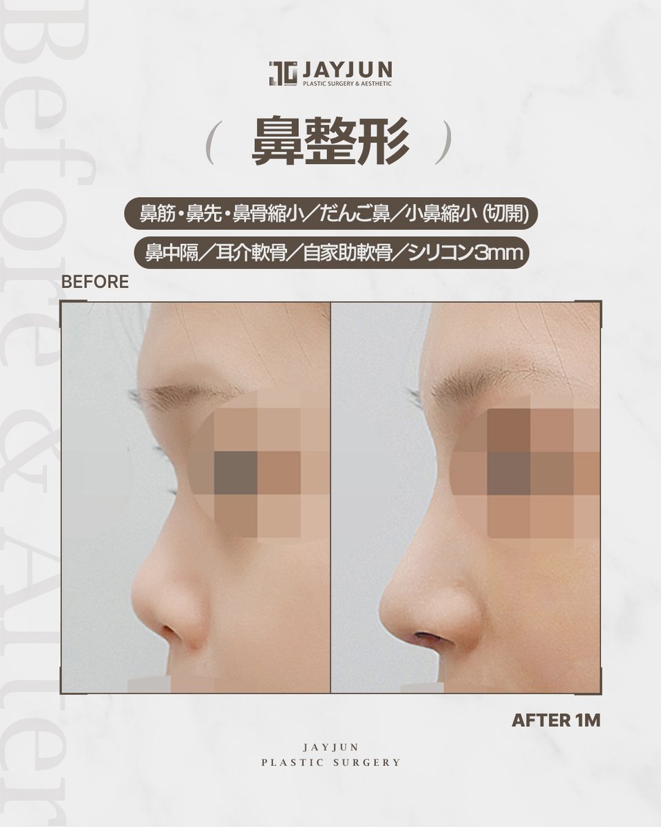 ✧ 鼻整形｜Before & After（術後1ヶ月） ✧ 《プロテーゼ3mm＋鼻尖