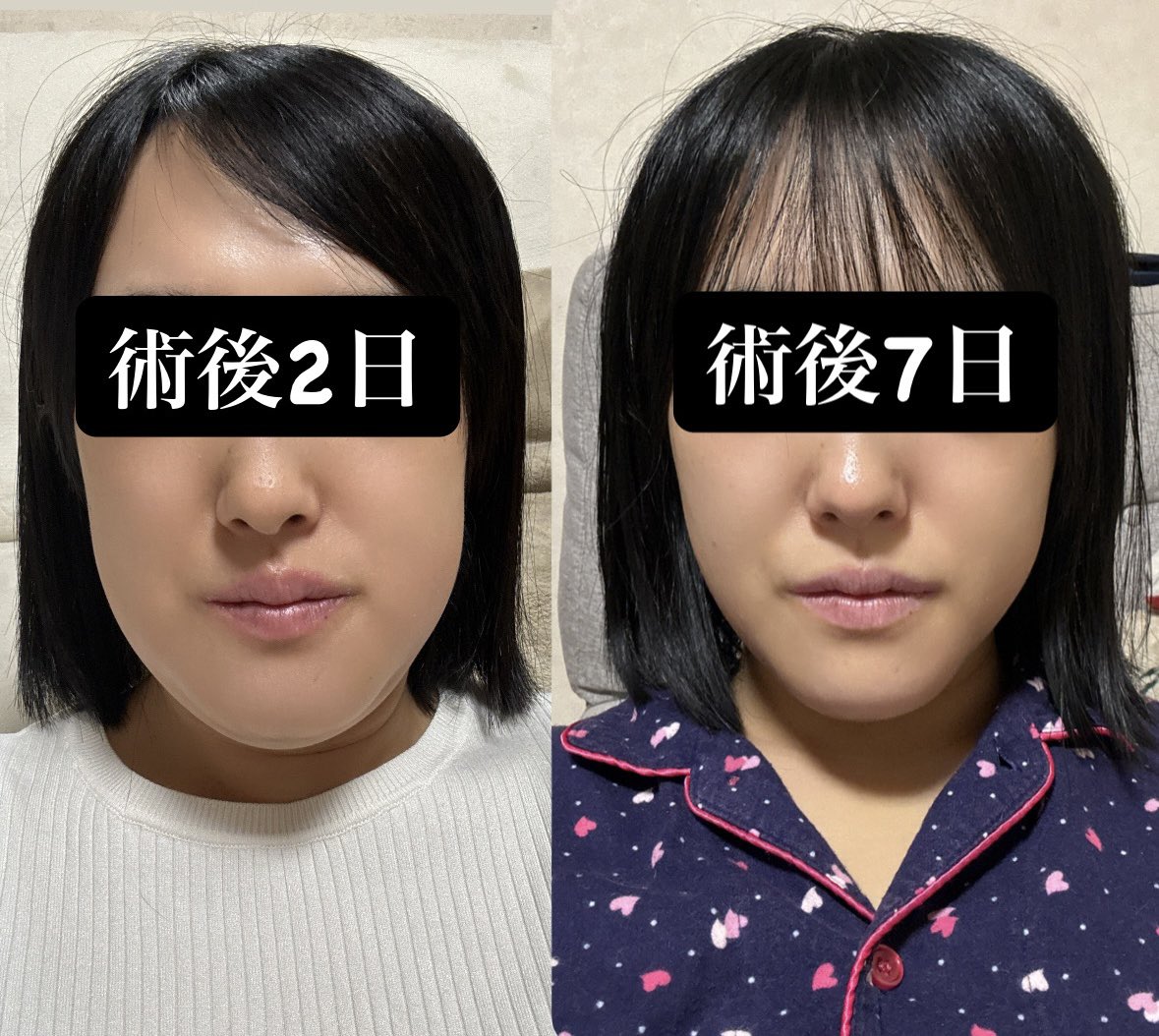 rkhpdnvv's tweet photo. 腫れが引いて輪郭が見えてきた！
ssroの時より腫れと出血がひどい気がする😫痛みは同じくらいかな😌

顎先に内出血があるからまだマスクしないと出歩けないけど、それがなくなる頃には腫れも落ち着いてマスクなしでも大丈夫になってるといいな
これからもっと引くと思うと楽しみ〜 https://t.co/jbmnQryq9R