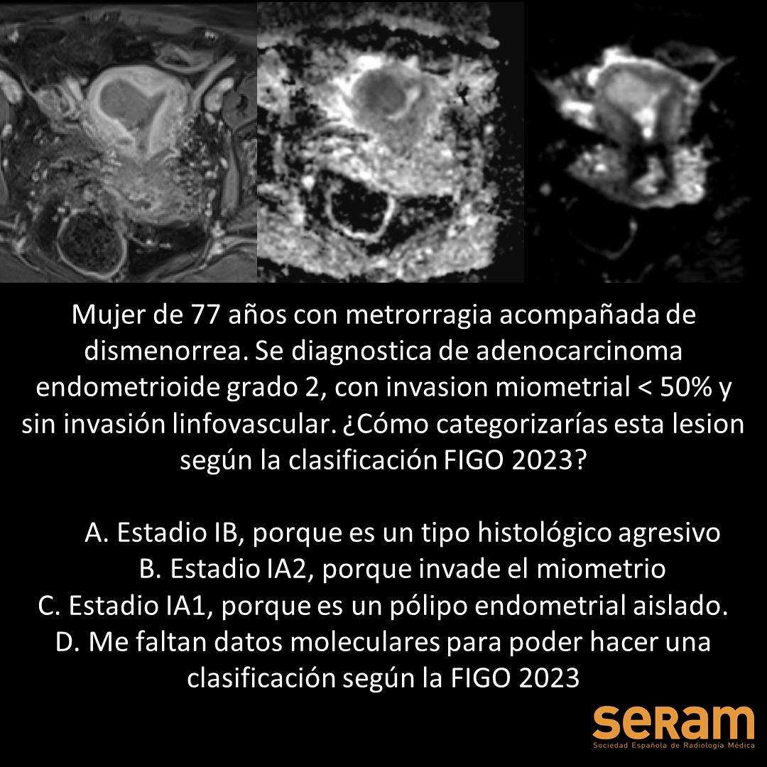 residentesSERAM's tweet photo. ¡Nuevo artículo recomendado! Nuestra compañera Paula Menor (@paulamenor_rx) del Complejo Asistencial Universitario de Salamanca nos presenta este artículo de @RevistaRADIOLO2 con las claves de la clasificación FIGO. ¿¿Sabrías contestar sin leerlo?? @SERAM_RX @sediabdomen https://t.co/MYDM8N9dE3