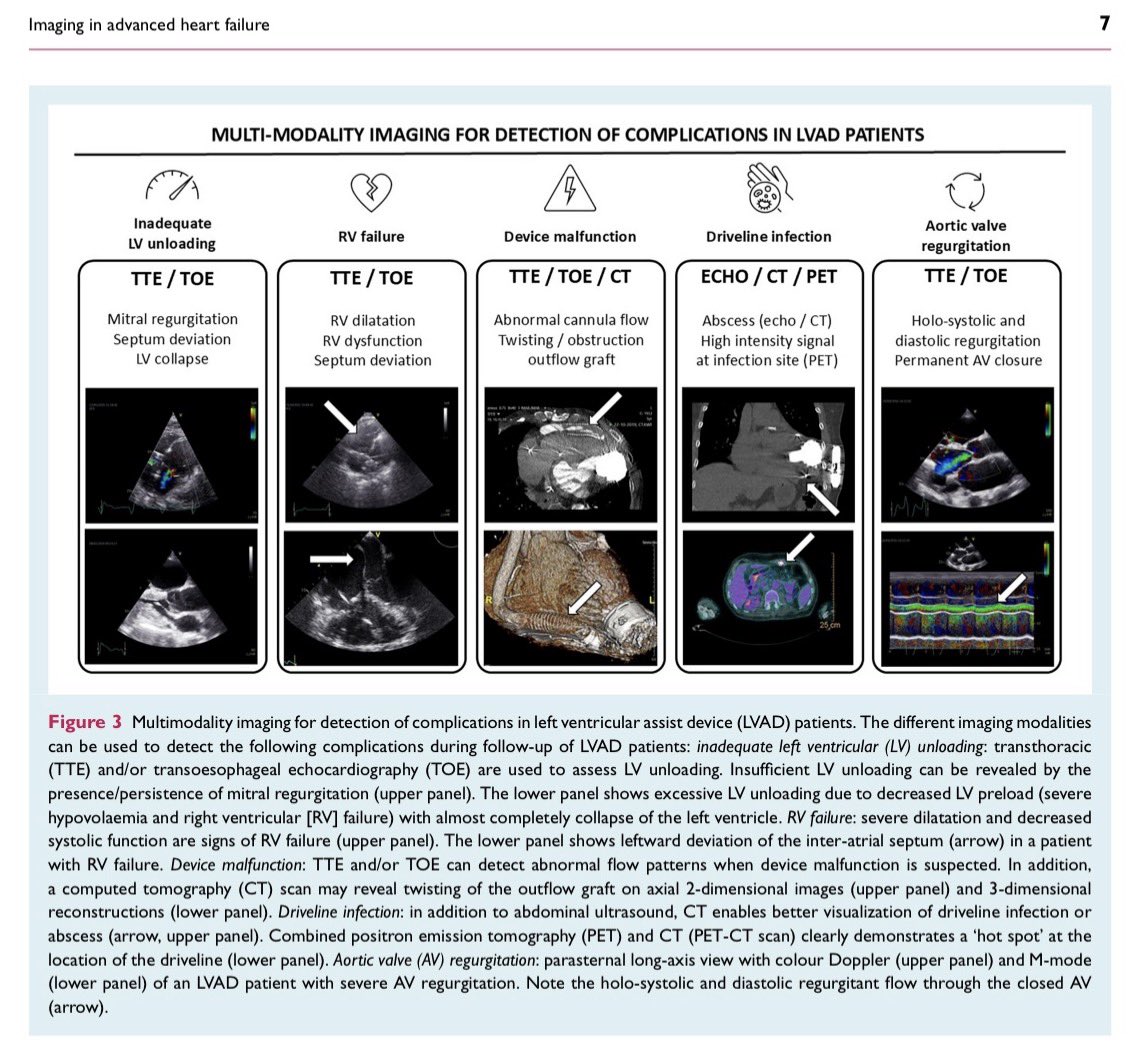 GiuseppeGalati_'s tweet photo. 🔥 Multimodality imaging in #AdvancedHF
A clinical consensus statement of the
#HFA of the @escardio.
Part 2:
Mechanical circulatory support &
heart transplantation 🔋⚙️🫀🔪
✅ Selection of candidates
✅ Ensuring proper device placement
✅Monitoring in the peri-implantation period
✅Early complications detection
✅Evaluation if ventricular unloading
@HFUAcademy 🫀 https://t.co/0dFvFm9NeT
@ESC_Journals @EJHFEiC
@GMCRosano @MarcoMetra
@RInciardi @cristina_gavina
@ShelleyZieroth @SeguraCardio
@glimongelli @KTamirisaMD @robmentz @mvaduganathan @AndrewJSauer @DrRajivsankar @gpontone1 @DrMarthaGulati @IacopoOlivotto @iamritu @JBauersachsMD @chiarabd
@AmrAbdin10 @HanCardiomd @AnastasiaSMihai @afgcicero @FedericaFogacci @FeliceGragnano
@HFA_President
https://t.co/9S8famnzzC