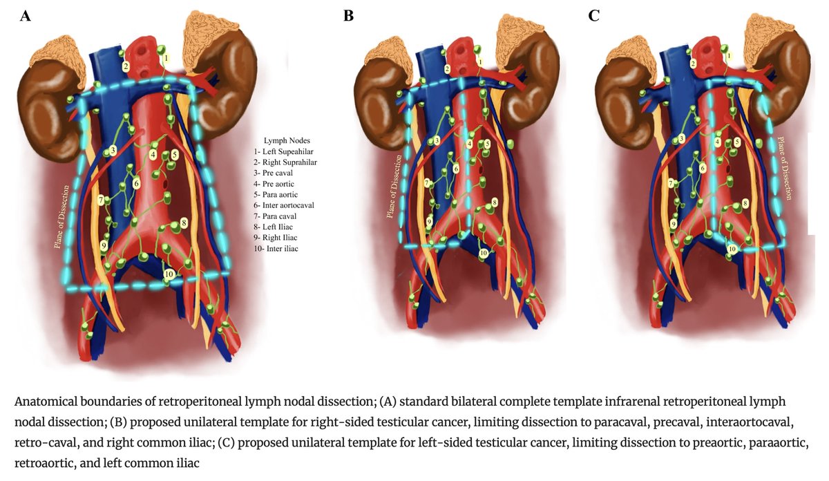 AnnSurgOncol's tweet image. December Issue: Can Contralateral Template Dissection be Avoided in Post-chemotherapy Retroperitoneal #LymphNodeDissection for Non-seminomatous #GermCellTumors ? @gurushankari_b
@anandoncologist

rdcu.be/eTl2w

@SyedAAhmad5
@SocSurgOnc
