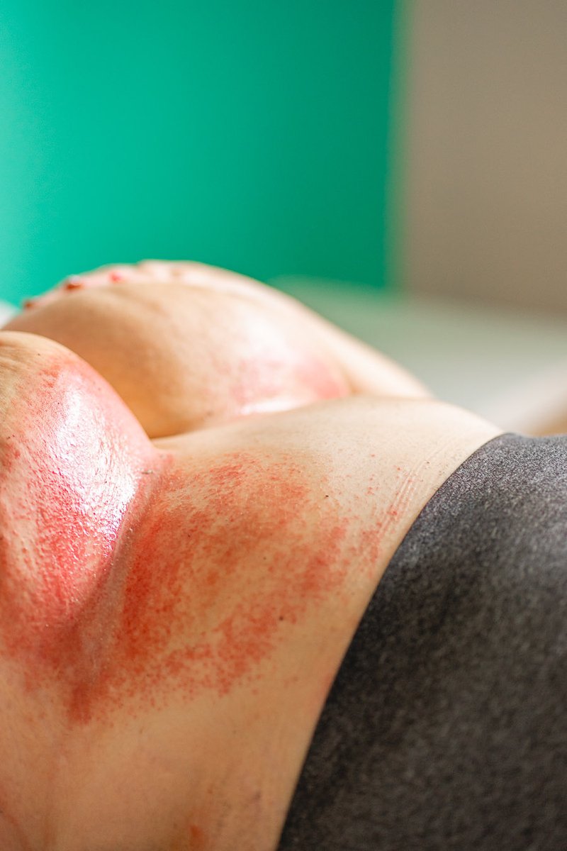 Iris_CU93's tweet image. #Psoriasis

No son hongos. Parecen.
Todo el mundo cree tener la solución.

Psoriasis en forma inversa apareció.
Dolorosa solo con verla.
Desesperante con sentirla.

Un biológico me limpió.
La inversa resistió.

No se ve. No es frecuente.
Duele.
Cada ducha una angustia permanente.