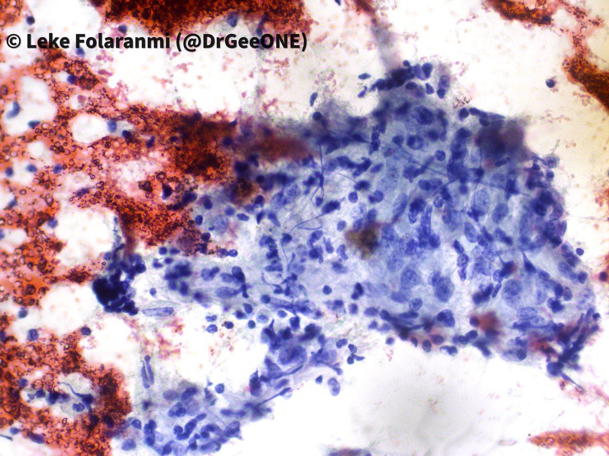 DrGeeONE's tweet image. I need your thoughts on this
A patient in late 20s who presented with submandibular mass of a year duration. USS suggests a benign submandibular gland mass.
#Cytopath #HNPath #Pathology