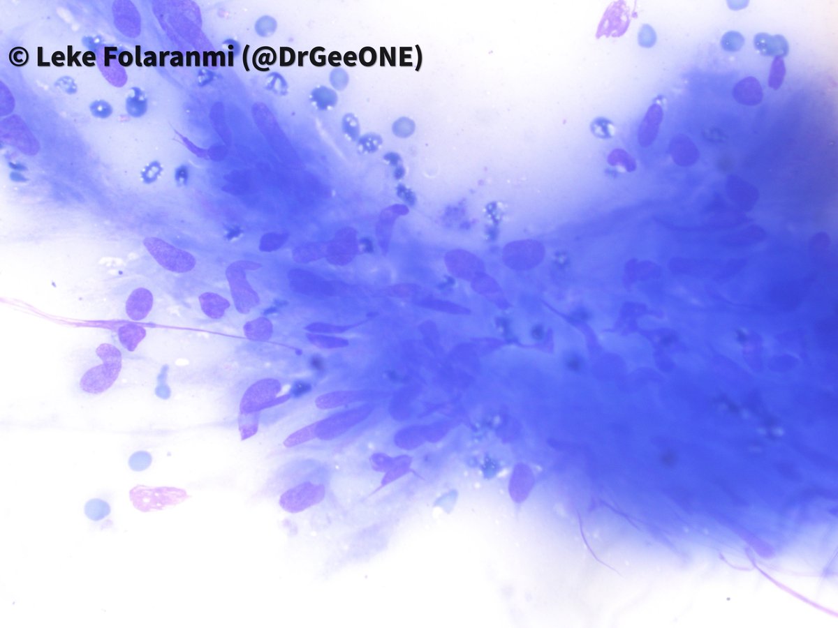 DrGeeONE's tweet image. I need your thoughts on this
A patient in late 20s who presented with submandibular mass of a year duration. USS suggests a benign submandibular gland mass.
#Cytopath #HNPath #Pathology