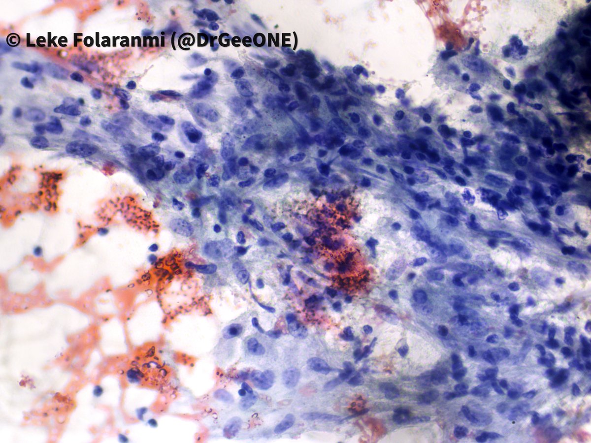 DrGeeONE's tweet image. I need your thoughts on this
A patient in late 20s who presented with submandibular mass of a year duration. USS suggests a benign submandibular gland mass.
#Cytopath #HNPath #Pathology