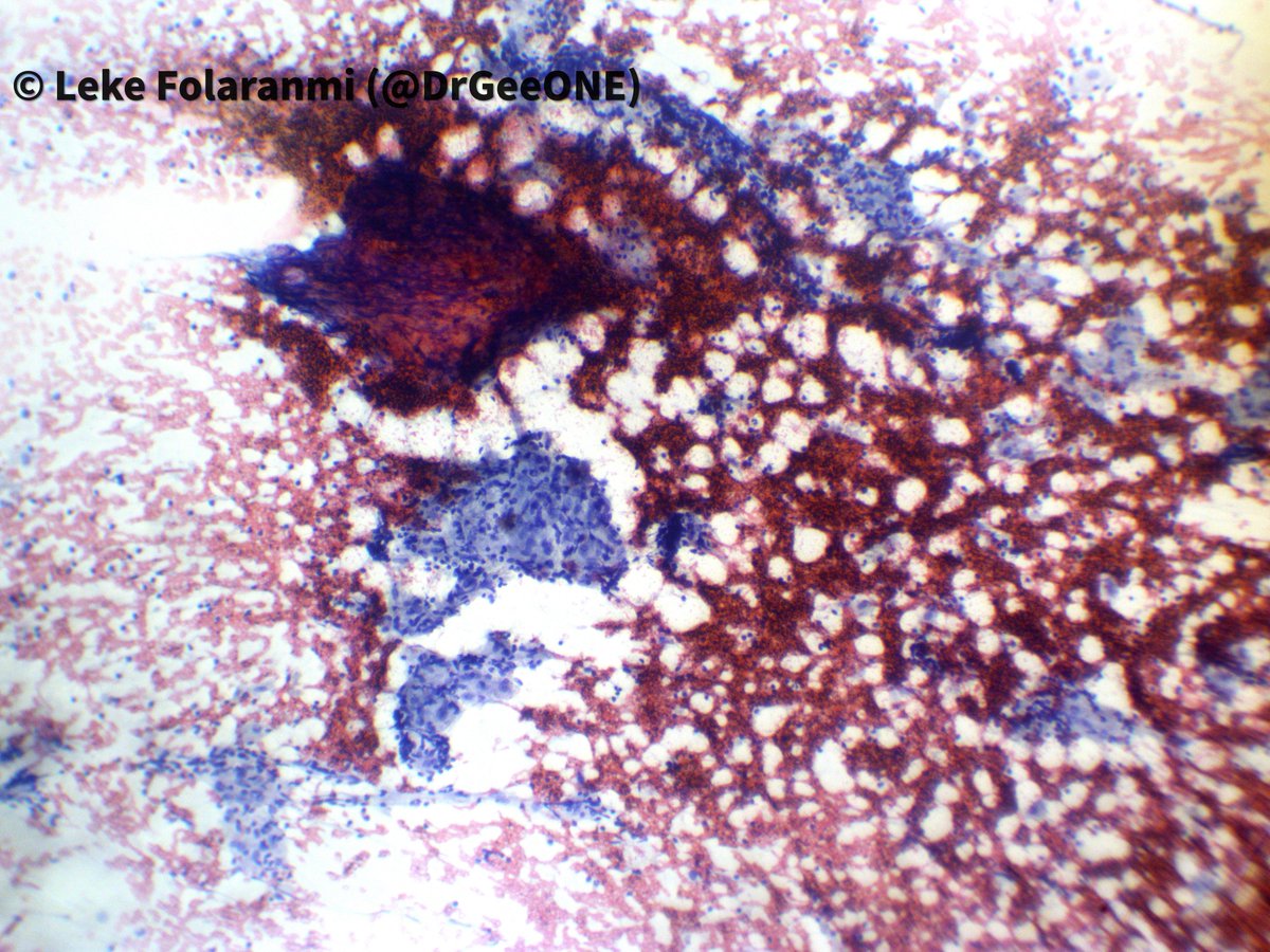 DrGeeONE's tweet image. I need your thoughts on this
A patient in late 20s who presented with submandibular mass of a year duration. USS suggests a benign submandibular gland mass.
#Cytopath #HNPath #Pathology
