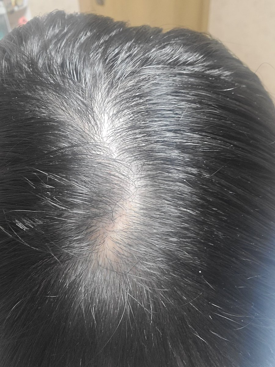떡진거아님
나름 머리숱부심 있었는데 쬐금 탈모왔어