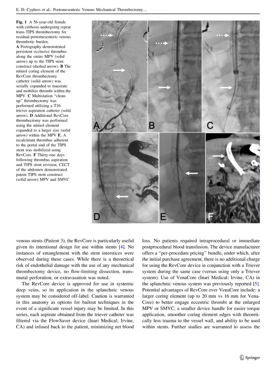 CHICKVIR's tweet photo. RevCore mechanical thrombectomy catheter may effectively and safely debulk organized or in-stent portomesenteric venous thrombi, restoring patency in challenging splanchnic venous thrombosis.

https://t.co/Ok3XMyA9Ti

@KeckMedicineUSC @UWRadiology @CVIR_Journal @InariMedical https://t.co/Zgmvn4znbd