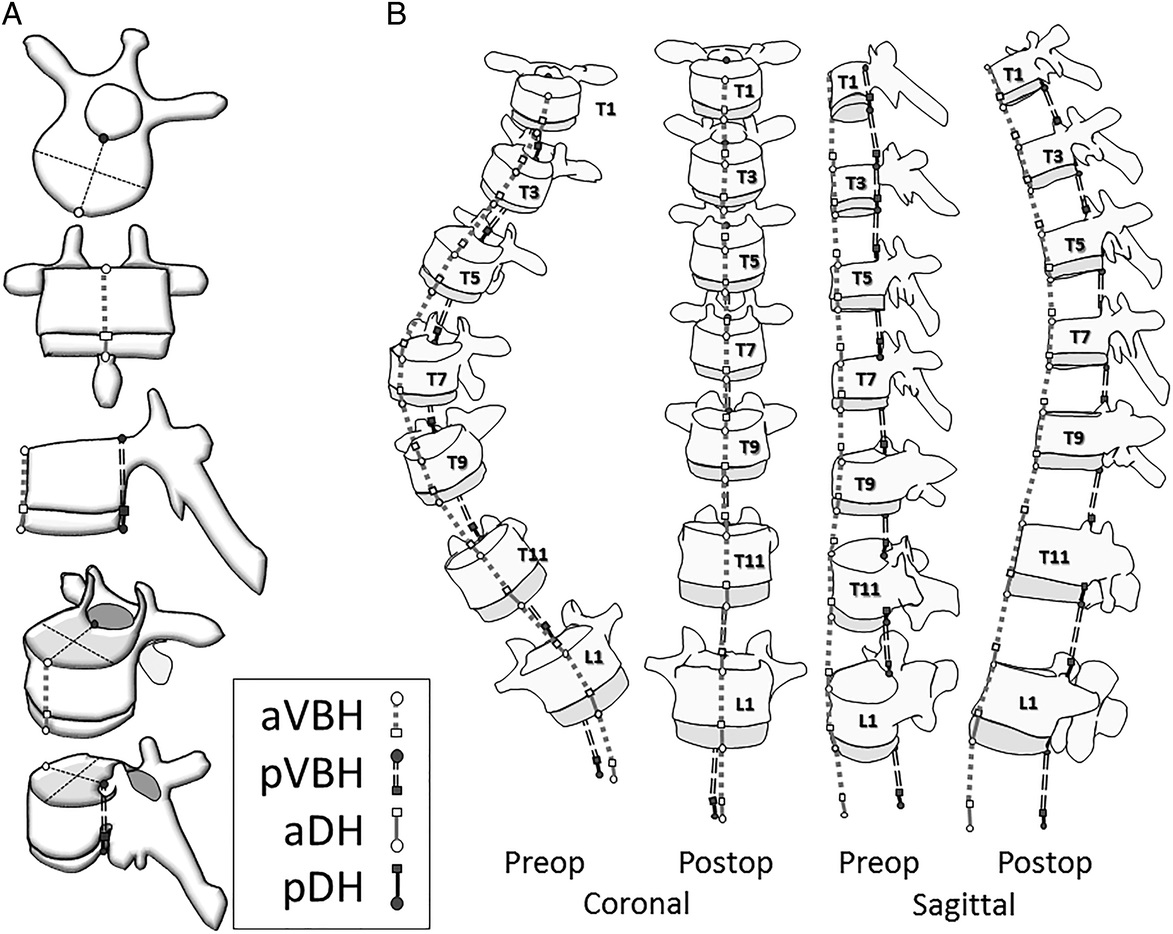 SpinePhilaPA76's tweet photo. ✨Featured: Researchers assessed 3D changes s/p AIS recon, w/ attention to AC shortening + MC lengthening in 564 pts.  Authors conclude that 3D kyphosis creation req shortening of the AC + lengthening of the MC through the discs

https://t.co/itam7OBVbh

#Deformity #SpineX #NSGY https://t.co/MfVp7iMwqc
