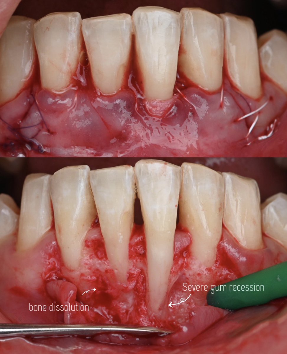 dr_suzan_banjar's tweet image. Severe recession in the Central Incisor area &amp;amp; bone dissolution
📍 عيادات دنتاليا كير - طريق الملك 
للحجز او الاستفسار 📞
920003341
0590631861 
.
#bonegraft #graft #gum #انحسار #انحسار_لثة #ذوبان_عظم