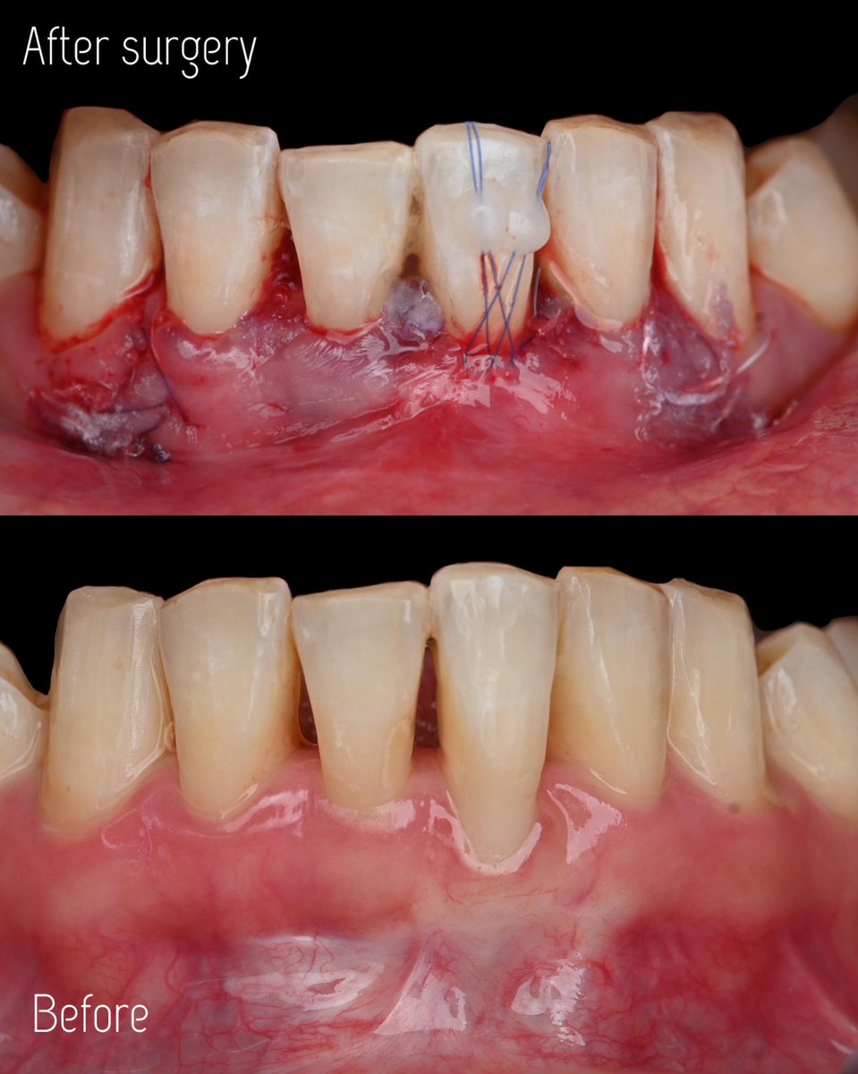 dr_suzan_banjar's tweet image. Severe recession in the Central Incisor area &amp;amp; bone dissolution
📍 عيادات دنتاليا كير - طريق الملك 
للحجز او الاستفسار 📞
920003341
0590631861 
.
#bonegraft #graft #gum #انحسار #انحسار_لثة #ذوبان_عظم
