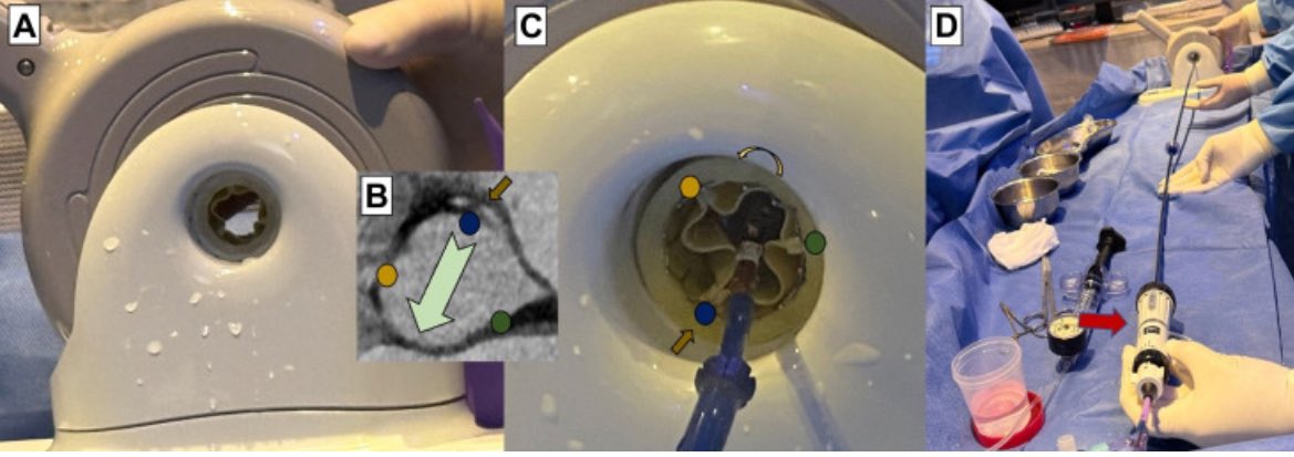 HA_Bruno07's tweet photo. “Coronary alignment is also possible with balloon-expandable valves using the neocommissural inversion technique.” 
@JACCJournals @GilbertTangMD @SyedZaidMD @AlcantaraCardio 

https://t.co/0d2mazsCii https://t.co/K1T6RKVv4L