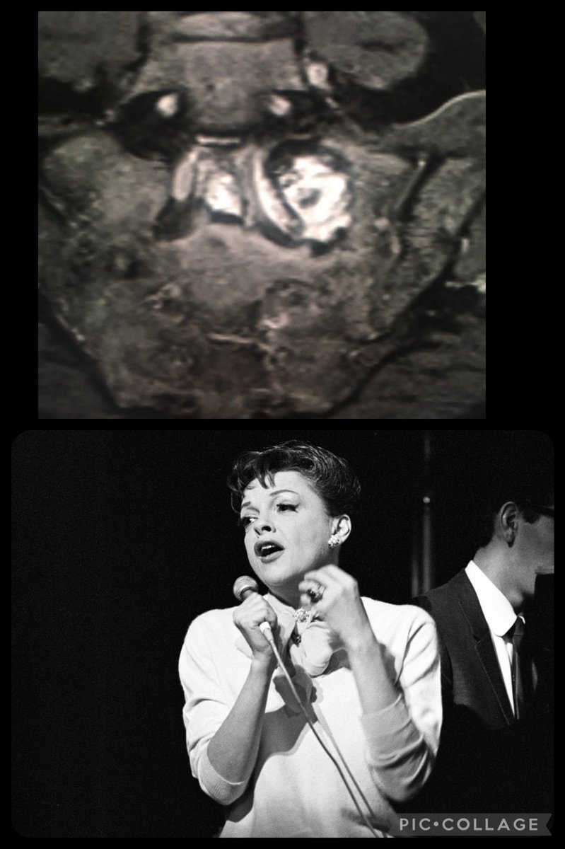 morrisonMSK's tweet photo. Sacrum in full cabaret mode https://t.co/9mL9FZLZOJ