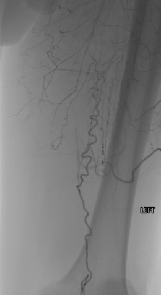 briangrantmd's tweet photo. Another great PAD result today. Atherectomy + balloon angioplasty restored strong blood flow with zero incisions. Life-changing for patients. Exciting photos below! #VascularHealth #PAD #Vascular @MedCenterHealth @MDTVascular https://t.co/jAWjQ5s1qp