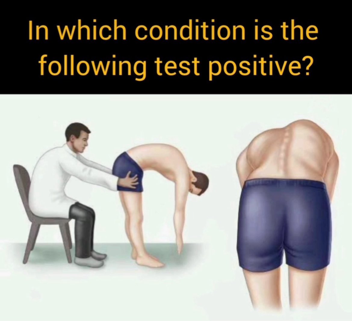 👨🏻‍⚕️ ماهي الحالة المرضية التي يكون فيها نتيجة هذا الاختبار إيجابي❓🤔