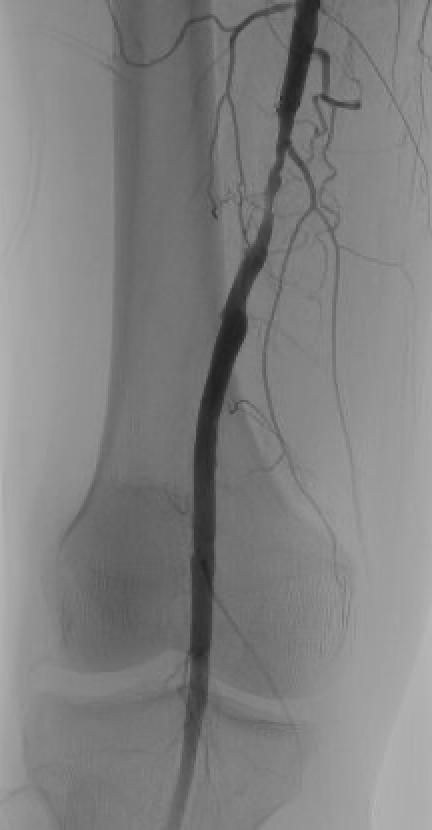 briangrantmd's tweet image. If leg pain stops you from walking, it might be PAD. We’re treating it with tiny catheters, atherectomy, and balloons—no open surgery. Before/after pics tell the story. #Endovascular #PAD #Vascular #claudication #Kentucky @MedCenterHealth @MDTVascular