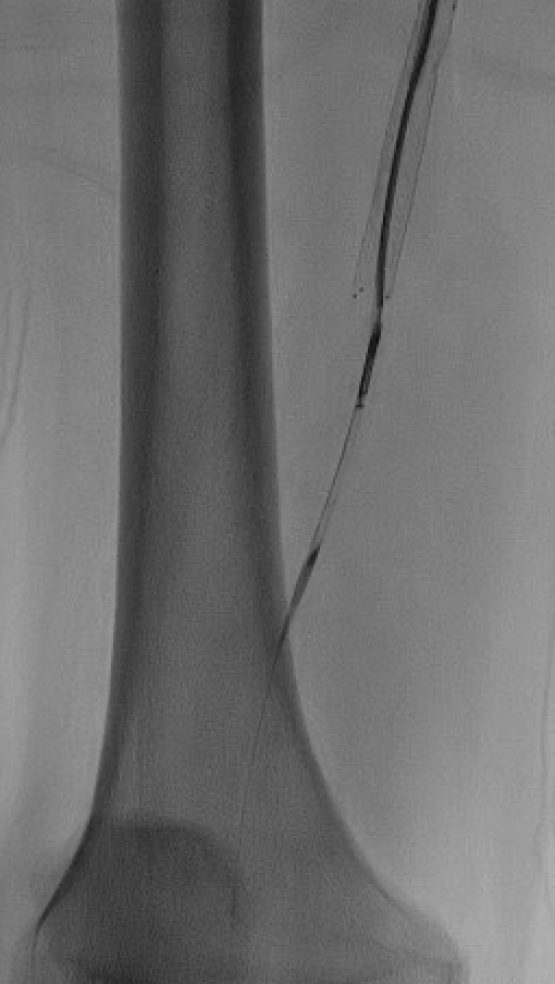 briangrantmd's tweet image. If leg pain stops you from walking, it might be PAD. We’re treating it with tiny catheters, atherectomy, and balloons—no open surgery. Before/after pics tell the story. #Endovascular #PAD #Vascular #claudication #Kentucky @MedCenterHealth @MDTVascular