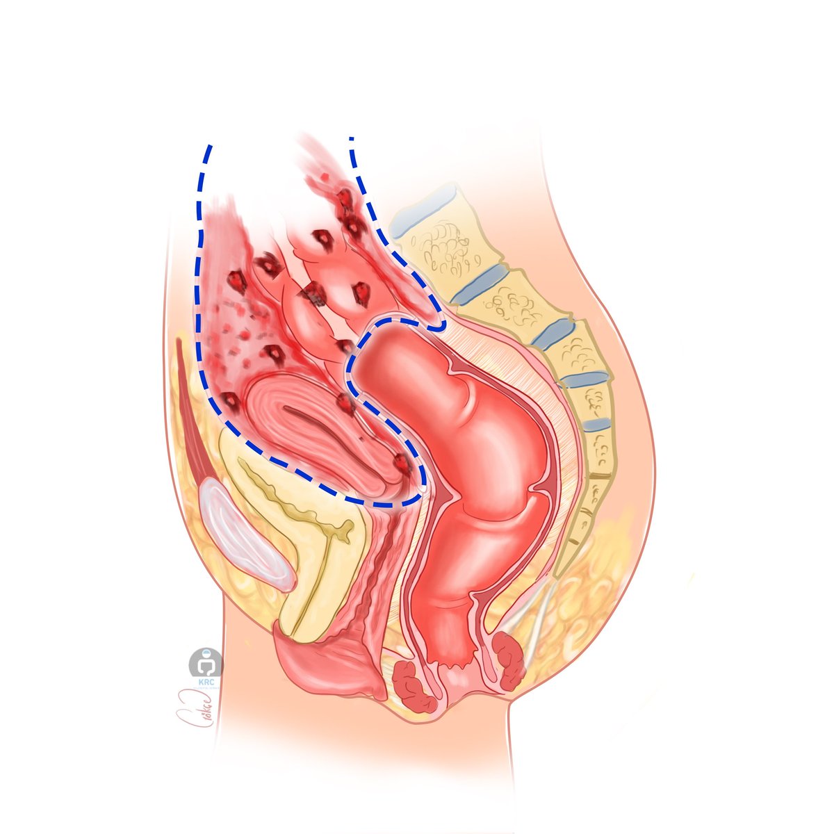 ArasEmreCanda's tweet photo. In advanced #ovariancancer, achieving complete macroscopic #cytoreduction (R0) remains the most important prognostic factor, as strongly emphasized by both #ESGO guidelines and #PSOGI #PelvEx consensus statements.
This patient had pelvis-confined peritoneal metastases, a pattern that often requires meticulous anatomical dissection and multivisceral procedures. Cytoreduction included en bloc pelvic peritonectomy, TAH/BSO, rectal resection, followeb by extended pelvic–paraaortic lymphadenectomy.
These steps are consistent with recommendations, which highlight the need for comprehensive compartment-based surgery when peritoneal surfaces of the pelvis are involved.
Because the disease was limited to the peritoneal cavity and complete cytoreduction was achieved, #HIPEC was also performed.
Key principles from PSOGI-ESGE-PelvEx consensus literature support its use in this context:
🔹 HIPEC may offer added benefit after R0/near-R0 cytoreduction in selected epithelial ovarian cancer patients.
🔹 A distribution- and biology-driven understanding of peritoneal metastases, where the extent of surgery is determined by the exact anatomic compartments affected.
🔹 Pelvic peritoneal metastases frequently require en bloc removal of affected peritoneal surfaces, fully in line with peritonectomy principles.
🔹 In accordance with PelvEx principles, when tumor biology and anatomical distribution require it, pelvic exenteration should also be considered to achieve complete cytoreduction.
These operations rely on a true multidisciplinary surgical model—including general surgery, gynecologic oncology, and, when required, urology—working in coordination with the medical oncology team. Accurate staging, operative planning, and postoperative management are further supported by radiology, nuclear medicine, and pathology, each contributing essential diagnostic and decision-making insights.
This case illustrates the extent of surgery in ovarian cancer is shaped by the disease’s anatomic spread, not by surgical preference.
When appropriate, combining cytoreductive surgery with HIPEC aims to optimize long-term oncologic outcomes.
We gratefully acknowledge Prof. Uğur Saygılı for his contribution to the gynecologic oncology aspects of this procedure, as well as all members of our multidisciplinary team whose coordinated efforts made this comprehensive surgical approach possible.
@acibademkent
#OvarianCancer #Overkanseri #peritonealmetastasis #peritonealkarsinomatoz #Cytoreductivesurgery #sitoredüktifcerrahi #HİPEK #Peritonectomy #SurgicalOncology #GynOnc