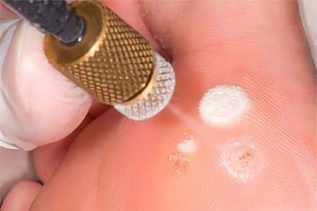 DrAlhajriDerma's tweet image. فيني ثآليل بالوجه والقدم ولا اعرف السبب؟

الثآليل سببها فيروسHPV وتنتقل بالتلامس
تختلف عن الزوائد اللحمية العادية بان سطحها عادة خشن وتتوالد 

⚠️بعض الحلاقين وعدم الاهتمام بالنظافة والتعقيم احد اهم اسباب انتشار ثاليل الوجه والرقبة

⚠️استخدام نعال الحمامات المشتركة، تكرمون، احد…