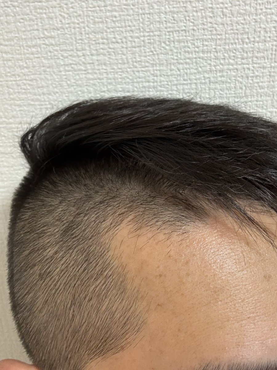 thurube_aga's tweet photo. 🌻リアップをM字部分につけ始めて、908日目。 https://t.co/7N3ZP0jFgo
