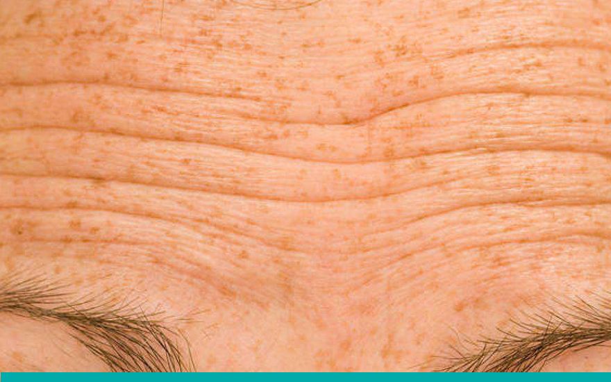 #EscuelaTabaquismo. El consumo de tabaco se relaciona directamente con la aparición de arrugas cutáneas y potencia la acción nociva del sol. buff.ly/CbX5jwN