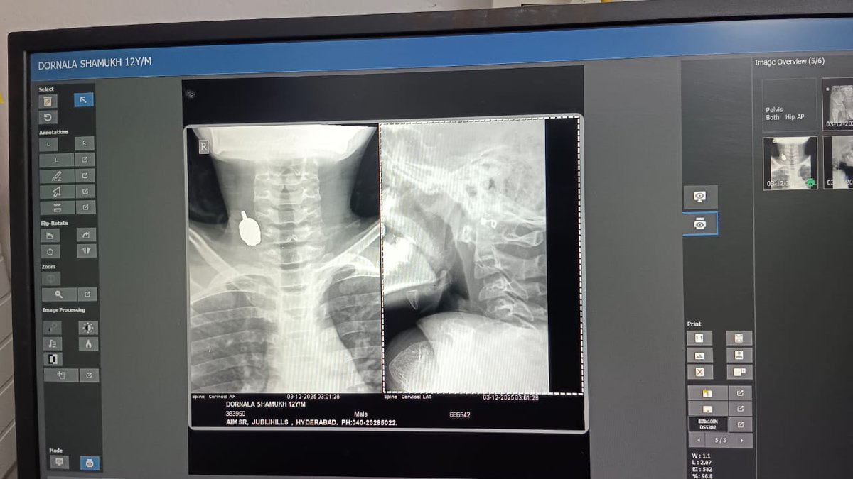 Jyotsna_JSP's tweet photo. This boy had an accident. He suffering multiple fractures, need 3 surgeries urgently, it would cost 5 lakhs.
Patient Name: D.Shanmukh, Apollo Hos-Filmnagar, 
🙏Plz help (Ph Pay: 9640367969) (A/c No: 62469797726-D.Madhu)
@PawanKalyan
@revanth_anumula
@KChiruTweets
@upasanakonidela https://t.co/0p7HRtLGlX