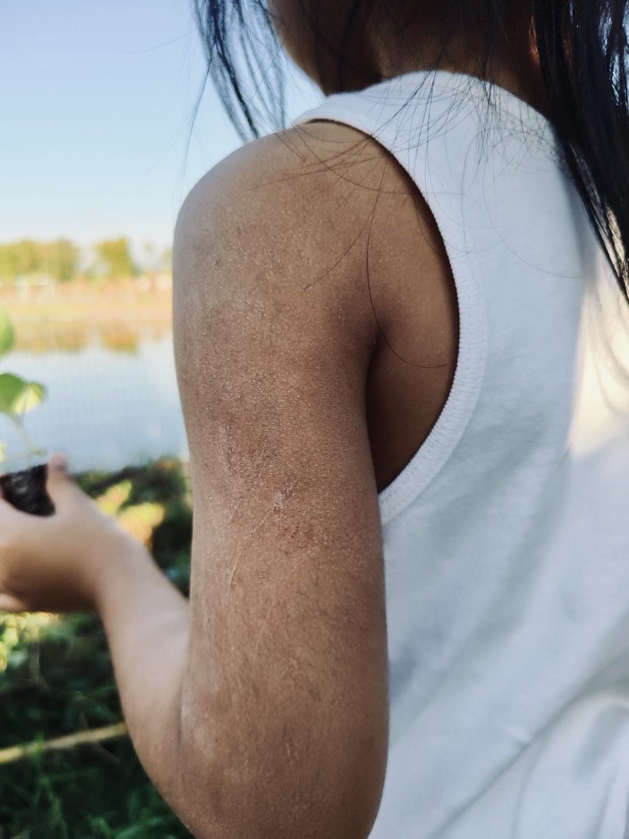 kuos2009's tweet image. ภัยหนาว ! 
🙏ผมขอรับบริจาครีมบำรุงผิวและออยเพื่อ นำไปแจกจ่ายให้เด็กๆยากไร้ได้ใช้ทาบรรเทาอาการผิวแห้งผิวแตกตากอากาศหนาว.

มูลนิธิบ้านนกขมิ้น เราขออาสาเป็นสะพานให้ท่านแบ่งปันสู่สังคม

ท่านสามารถนำมาบริจาคได้ที่
บ้านนกขมิ้นหรือจะส่งทางไปรษณีย์ 
หรือสั่งผ่าน Shopee Lazada…