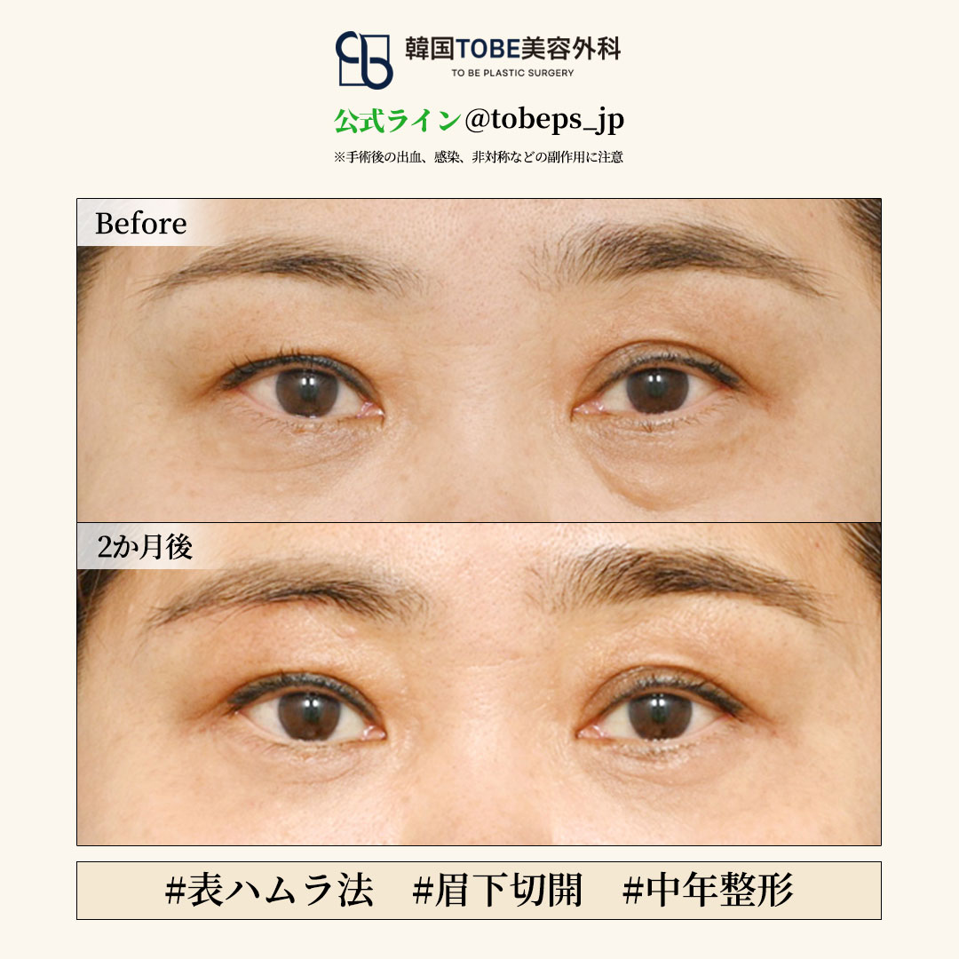 TOBEで叶える中年整形ご紹介🎀
♡上眼瞼切開
♡表ハムラ法
♡眉下リフト
♡額挙上 etc…

☁たるんだ二重まぶたで目が小さく見える
☁目の下のしわとクマがひどい

お顔の構造を丁寧に診断し、
再手術のいらない最適なプランをご提案👩‍⚕️

目の専門医へカウセ予約💘
line.me/R/ti/p/@tobeps… 

#渡韓整形