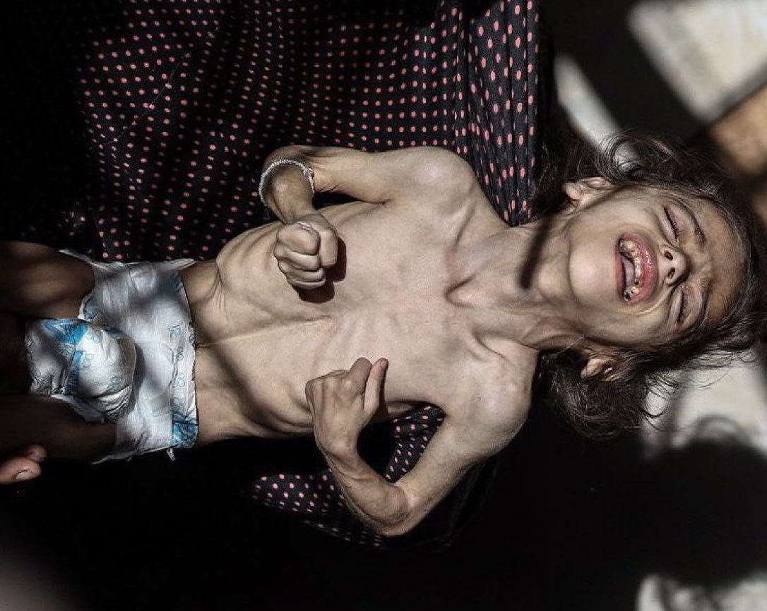 If it is - which, in fact, it is not - blame HAMAS. Read how Hamas stole the aid, including infant formula &amp; trashed it. Read how Hamas charges Pals for food they steal in connivance w/UNRWA. (BTW, this photo was debunked months ago. His mother &amp; brother are in it, not emaciated.…