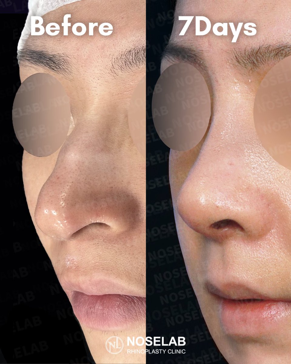 こんばんは。 クローズ法・鼻拘縮・鼻再建手術を専門としている